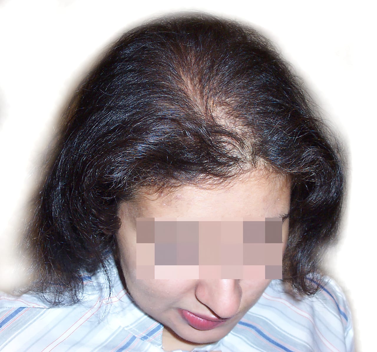 Before Picture - Androgenetic Alopecia / Stress